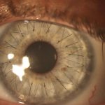 Fotografías de ojos después de un trasplante de córneas