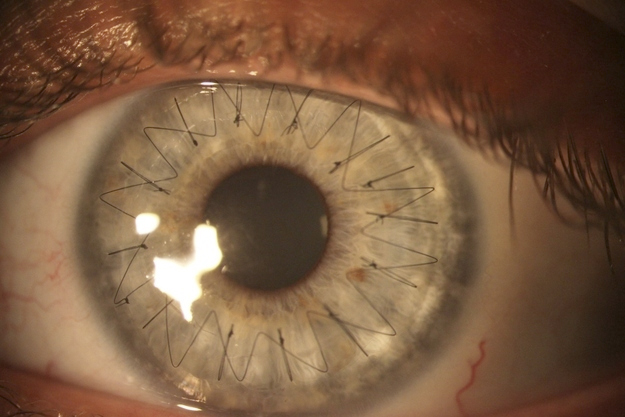 Fotografías de ojos después de un trasplante de córneas