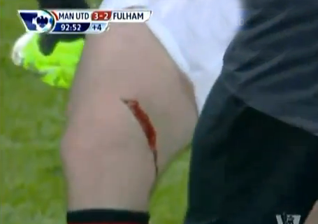 Impresionante corte en la pierna del futbolista Wayne Rooney durante un partido