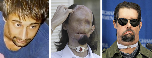13 impresionantes transplantes de cara con su historia