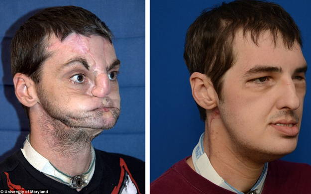El transplante de cara más completo del mundo, 7 meses después