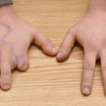 Pierde dos dedos de una mano en un accidente de moto y le ponen en su lugar dos dedos de los pies