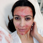 Kim Kardashian se hace un 'facial de sangre'