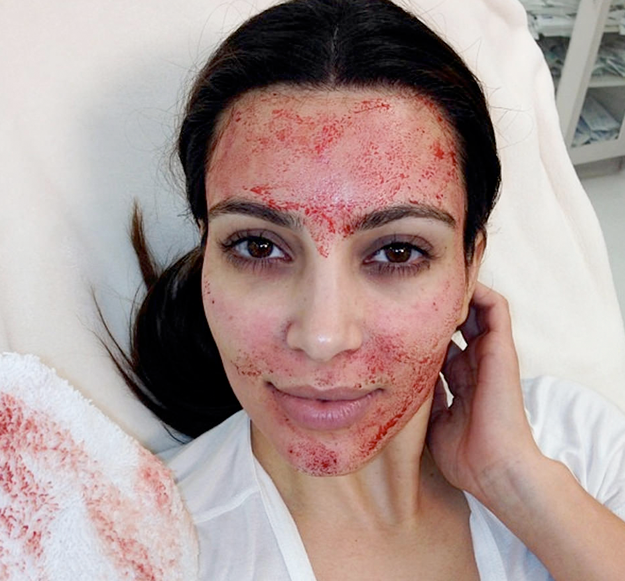 Kim Kardashian se hace un 'facial de sangre'
