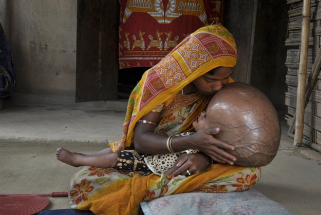 Roona Begum, una niña india con la cabeza hinchada debido a la hidrocefalia