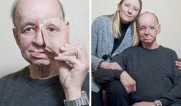 Una impresora 3D le devuelve a un hombre su rostro y calidad de vida