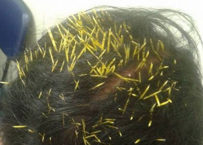 Una mujer hospitalizada con 200 púas clavadas en su cabeza después de caerle un erizo en la cabeza mientras paseaba al perro