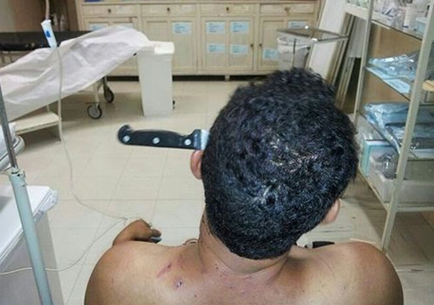 Un hombre llega a pie al hospital con un cuchillo clavado en la cabeza