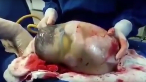 Una enfermera graba el momento en el que un bebé nace con la bolsa amniótica sin romper