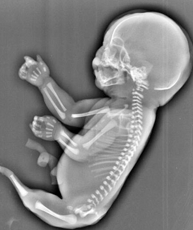 Una mujer decide abortar un feto con 'Sirenomelia': Las piernas unidas en forma de cola