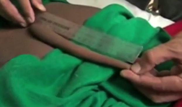 Médicos le cortan una cola de 18 cm. a un joven en la India. El chico no aguantaba más el dolor después de 18 años con ella