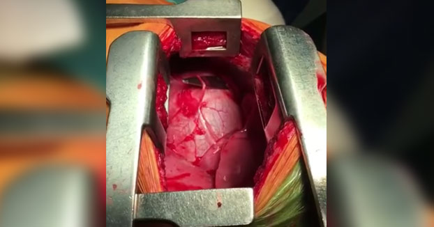 La increíble extracción de un cuchillo a corazón abierto (Vídeo)