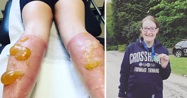 Una joven sufre graves quemaduras tras correr más de 100 kilómetros a pleno sol