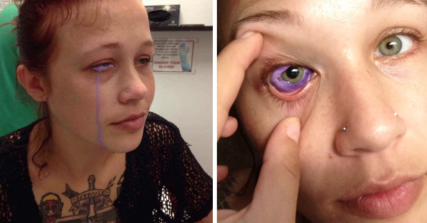 Una modelo de 24 años pierde la vista de un ojo después de hacerse un tatuaje en él