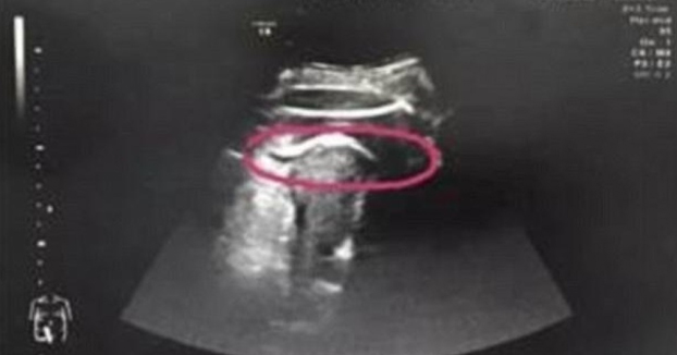 Una mujer embarazada, a punto de morir tras recibir una fortísima patada del feto en el útero