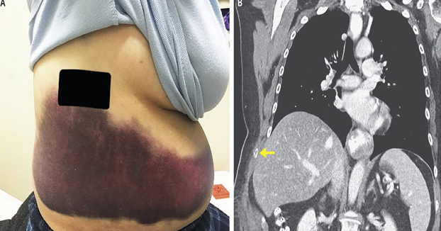 Una mujer de 66 años se rompe una costilla en un ataque de tos