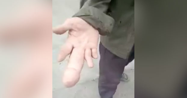 agenesia dedos de la mano película