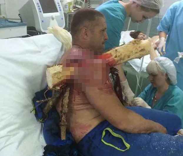 Un parapentista sufre un accidente y un tronco le atraviesa su cuerpo. Cuando llegó al hospital dijo: ''¡Soy Groot!''