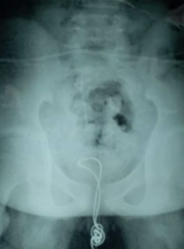 Un adolescente hospitalizado por enchufarse un cable USB en el pene