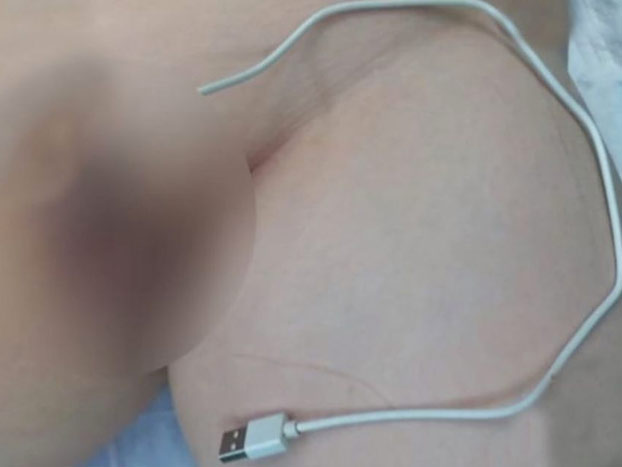 Un adolescente hospitalizado por enchufarse un cable USB en el pene