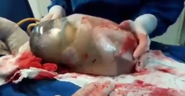 Un bebé sale del vientre de su madre sin romper el saco amniótico