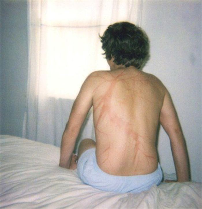 19 personas que sobrevivieron tras caerles un rayo muestran lo que causa en la piel