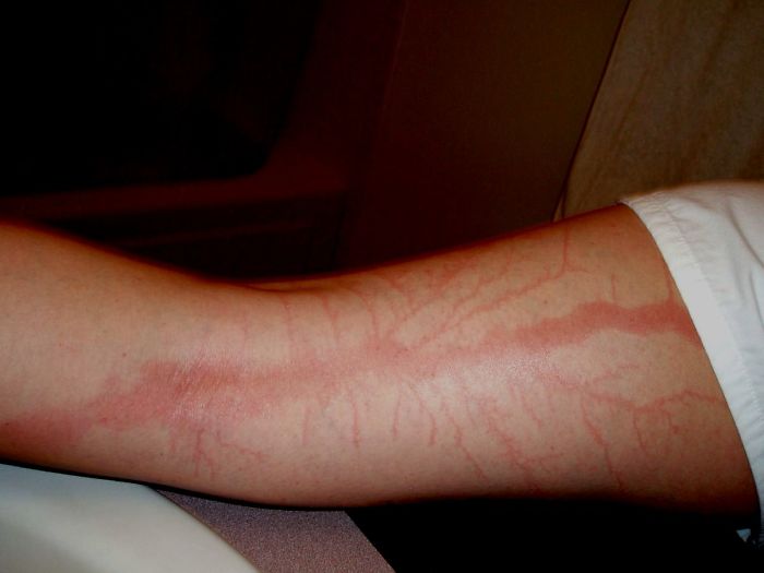 19 personas que sobrevivieron tras caerles un rayo muestran lo que causa en la piel