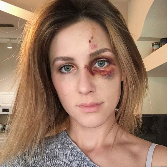 Campeón de Motocross golpeó brutalmente a su novia por una foto en Instagram