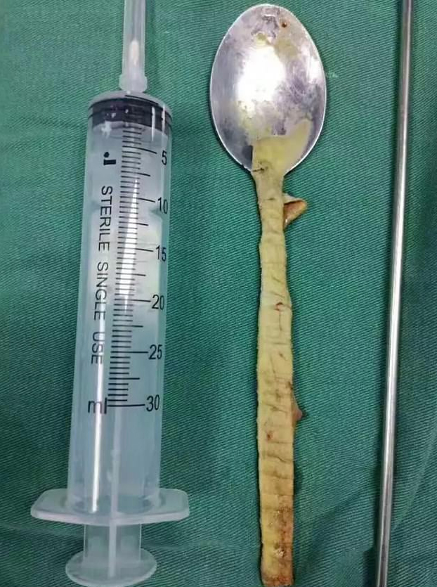 Se traga una cuchara de 20 centímetros y acude al hospital a que se la quiten un año después