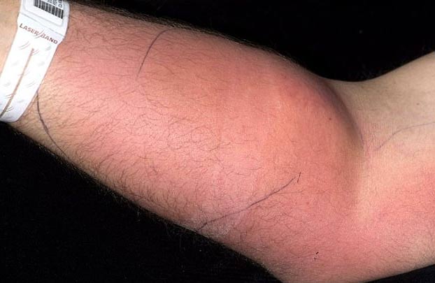 Un joven de 33 años se inyecta su propio semen en el brazo para curar un dolor de espalda