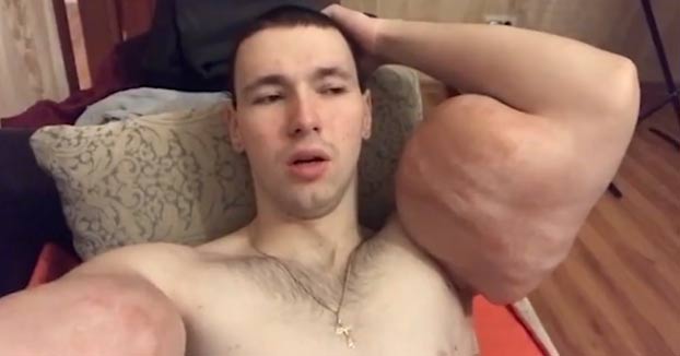 Kirill Tereshin, el Popeye ruso, se graba un vídeo para enseñar como tiene sus brazos un año después de inyectarse synthol