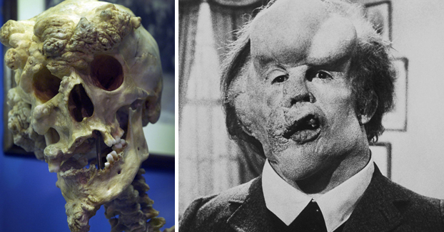 El cráneo de Joseph Merrick, más conocido como el ''hombre elefante''