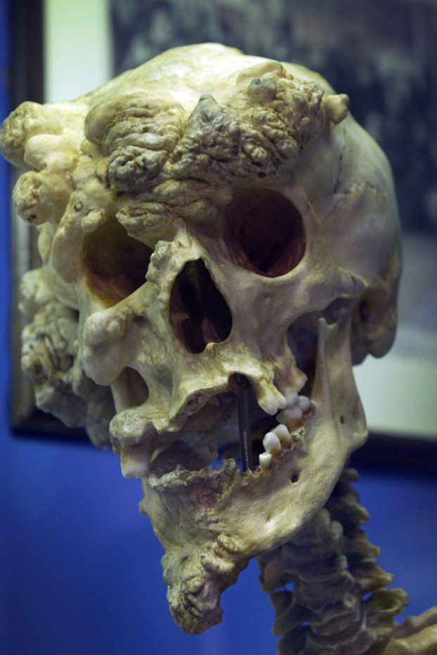 El cráneo de Joseph Merrick, más conocido como el ''hombre elefante''