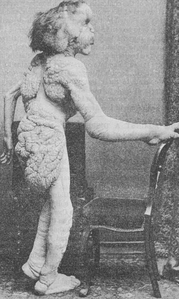 El cráneo de Joseph Merrick, más conocido como el ''hombre elefante''