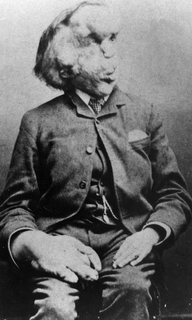 El cráneo de Joseph Merrick, más conocido como el ''hombre elefante''