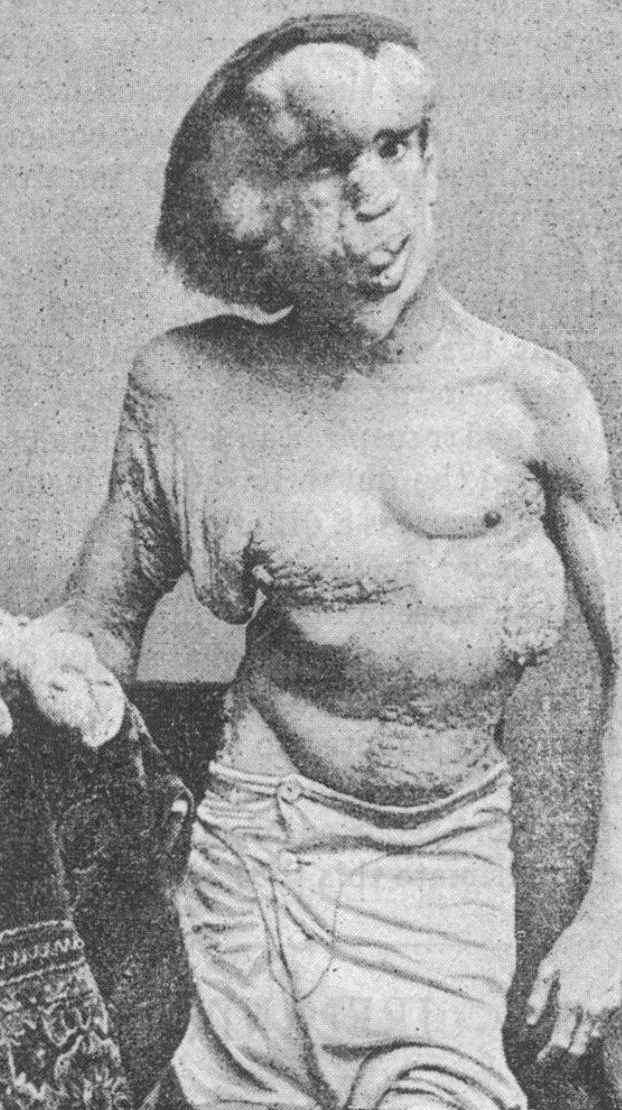 El cráneo de Joseph Merrick, más conocido como el ''hombre elefante''