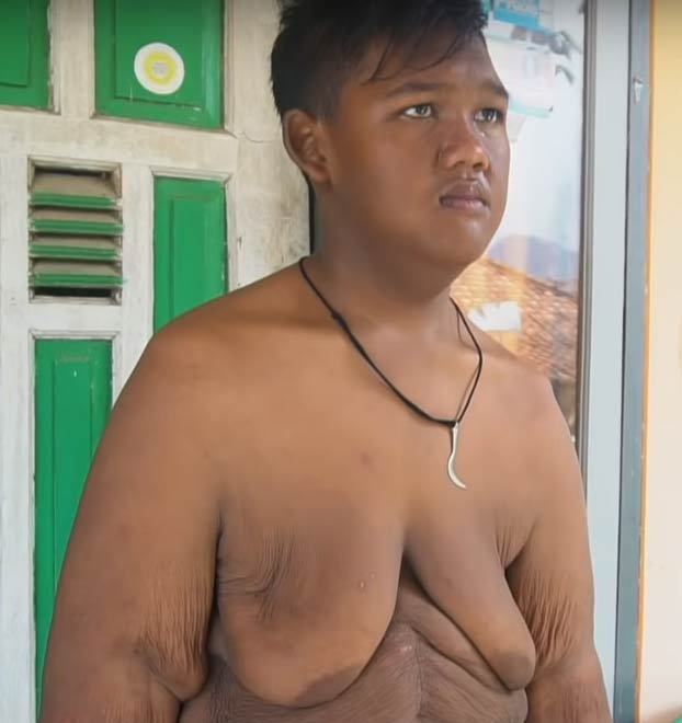 El cambio radical de Arya Permana, el niño más gordo del mundo. Ha perdido 100 kilos