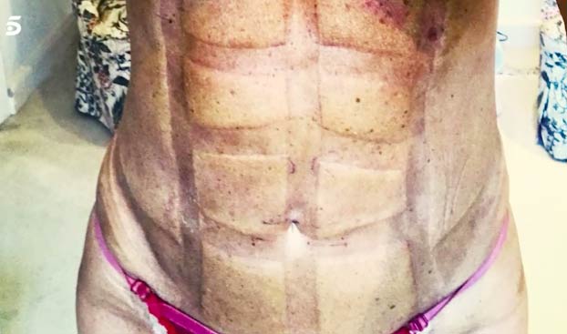 Imagen de los abdominales de Leticia Sabater después de operarse para parecerse a Madonna