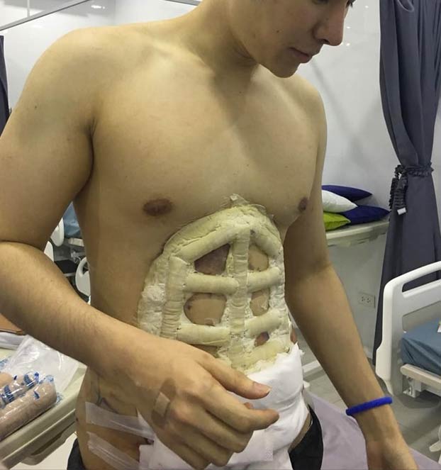 Un hospital ofrece cirugía instantánea para conseguir un six-pack bien definido