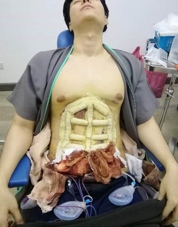 Un hospital ofrece cirugía instantánea para conseguir un six-pack bien definido