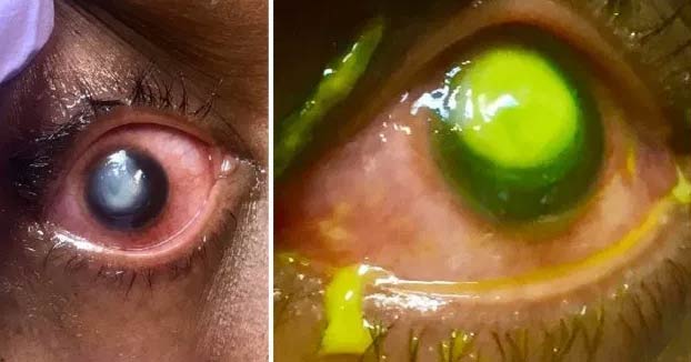 La advertencia de un oftalmólogo a quienes duermen con lentillas: ''La gente tiene que ver esto''