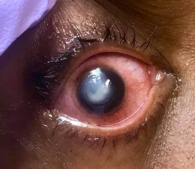 La advertencia de un oftalmólogo a quienes duermen con lentillas: ''La gente tiene que ver esto''