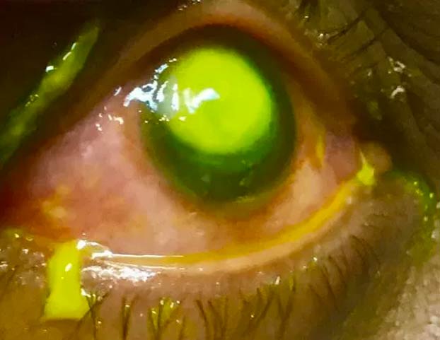 La advertencia de un oftalmólogo a quienes duermen con lentillas: ''La gente tiene que ver esto''