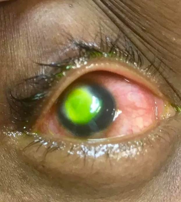 La advertencia de un oftalmólogo a quienes duermen con lentillas: ''La gente tiene que ver esto''