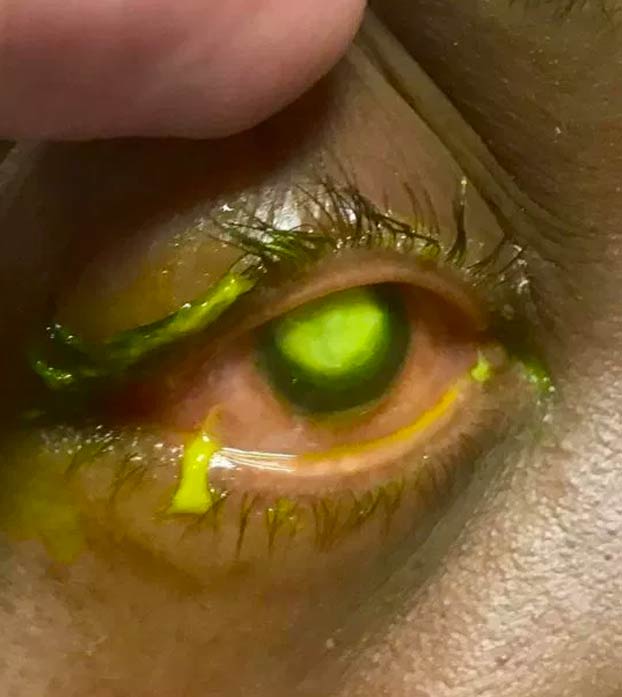 La advertencia de un oftalmólogo a quienes duermen con lentillas: ''La gente tiene que ver esto''