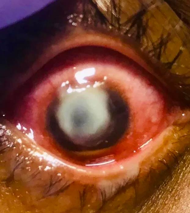 La advertencia de un oftalmólogo a quienes duermen con lentillas: ''La gente tiene que ver esto''