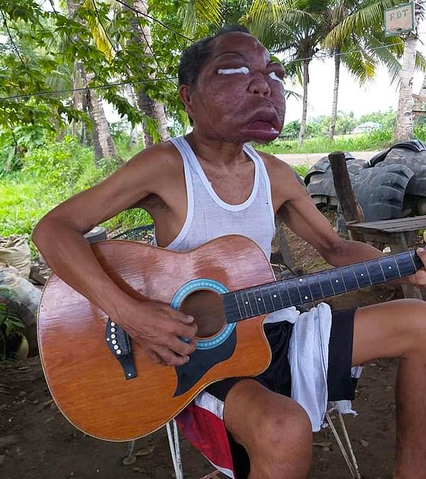 La cara de este hombre se hinchó después de una misteriosa enfermedad