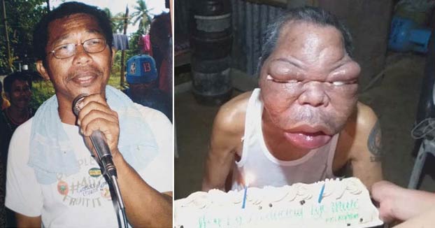 La cara de este hombre se hinchó después de una misteriosa enfermedad