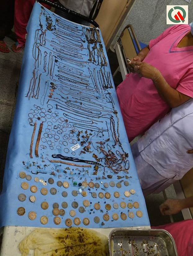 Extraen quirúrgicamente un montón de monedas y joyas del estómago de una joven de 26 años