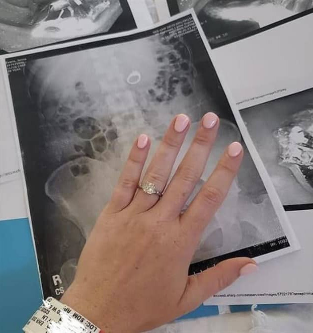 Una mujer se traga su anillo de compromiso mientras dormía